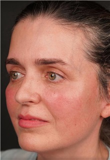 Facelift After Photo by Guncel Ozturk, Assoc. Prof. Dr, FEBOPRAS; Istanbul, M - Case 50984