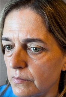 Facelift Before Photo by Guncel Ozturk, Assoc. Prof. Dr, FEBOPRAS; Istanbul, M - Case 50984