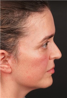 Facelift After Photo by Guncel Ozturk, Assoc. Prof. Dr, FEBOPRAS; Istanbul, M - Case 50984