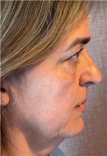 Facelift Before Photo by Guncel Ozturk, Assoc. Prof. Dr, FEBOPRAS; Istanbul, M - Case 50984