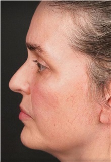 Facelift After Photo by Guncel Ozturk, Assoc. Prof. Dr, FEBOPRAS; Istanbul, M - Case 50984