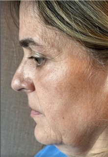 Facelift Before Photo by Guncel Ozturk, Assoc. Prof. Dr, FEBOPRAS; Istanbul, M - Case 50984