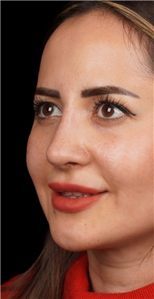 Rhinoplasty After Photo by Guncel Ozturk, Assoc. Prof. Dr, FEBOPRAS; Istanbul, M - Case 50981