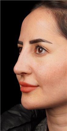 Rhinoplasty Before Photo by Guncel Ozturk, Assoc. Prof. Dr, FEBOPRAS; Istanbul, M - Case 50981