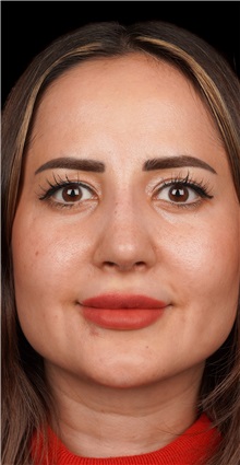 Rhinoplasty After Photo by Guncel Ozturk, Assoc. Prof. Dr, FEBOPRAS; Istanbul, M - Case 50981
