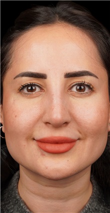 Rhinoplasty Before Photo by Guncel Ozturk, Assoc. Prof. Dr, FEBOPRAS; Istanbul, M - Case 50981