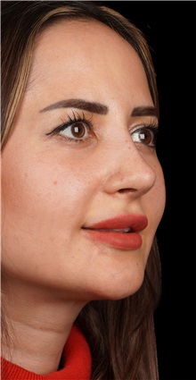 Rhinoplasty After Photo by Guncel Ozturk, Assoc. Prof. Dr, FEBOPRAS; Istanbul, M - Case 50981