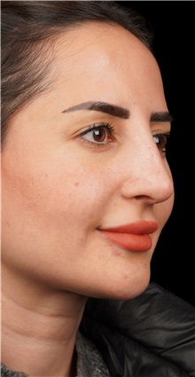 Rhinoplasty Before Photo by Guncel Ozturk, Assoc. Prof. Dr, FEBOPRAS; Istanbul, M - Case 50981