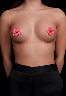 Breast Augmentation After Photo by Guncel Ozturk, Assoc. Prof. Dr, FEBOPRAS; Istanbul, M - Case 50982