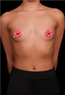 Breast Augmentation Before Photo by Guncel Ozturk, Assoc. Prof. Dr, FEBOPRAS; Istanbul, M - Case 50982