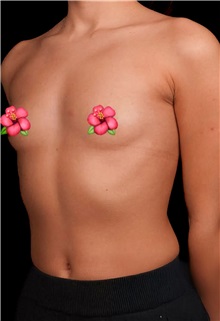 Breast Augmentation Before Photo by Guncel Ozturk, Assoc. Prof. Dr, FEBOPRAS; Istanbul, M - Case 50982