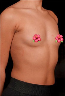 Breast Augmentation Before Photo by Guncel Ozturk, Assoc. Prof. Dr, FEBOPRAS; Istanbul, M - Case 50982