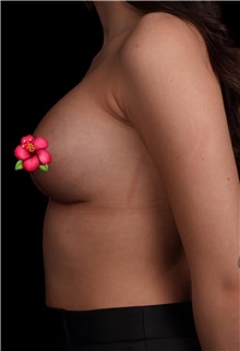 Breast Augmentation After Photo by Guncel Ozturk, Assoc. Prof. Dr, FEBOPRAS; Istanbul, M - Case 50982
