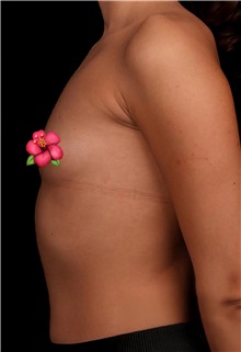 Breast Augmentation Before Photo by Guncel Ozturk, Assoc. Prof. Dr, FEBOPRAS; Istanbul, M - Case 50982