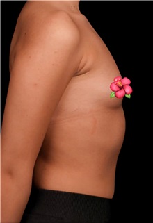 Breast Augmentation Before Photo by Guncel Ozturk, Assoc. Prof. Dr, FEBOPRAS; Istanbul, M - Case 50982