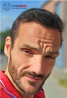 Hair Transplant After Photo by Guncel Ozturk, Assoc. Prof. Dr, FEBOPRAS; Istanbul, M - Case 50995