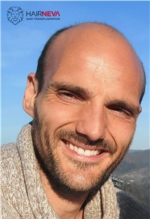 Hair Transplant Before Photo by Guncel Ozturk, Assoc. Prof. Dr, FEBOPRAS; Istanbul, M - Case 50995