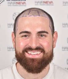 Hair Transplant Before Photo by Guncel Ozturk, Assoc. Prof. Dr, FEBOPRAS; Istanbul, M - Case 50998
