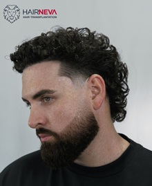 Hair Transplant After Photo by Guncel Ozturk, Assoc. Prof. Dr, FEBOPRAS; Istanbul, M - Case 50998