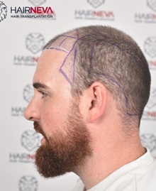 Hair Transplant Before Photo by Guncel Ozturk, Assoc. Prof. Dr, FEBOPRAS; Istanbul, M - Case 50998