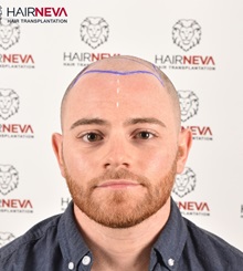 Hair Transplant Before Photo by Guncel Ozturk, Assoc. Prof. Dr, FEBOPRAS; Istanbul, M - Case 50994