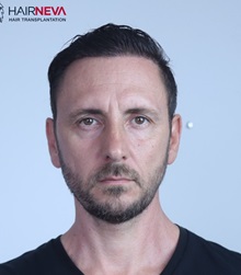 Hair Transplant After Photo by Guncel Ozturk, Assoc. Prof. Dr, FEBOPRAS; Istanbul, M - Case 50996