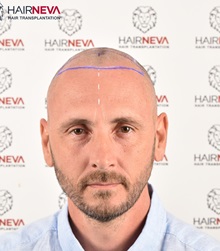 Hair Transplant Before Photo by Guncel Ozturk, Assoc. Prof. Dr, FEBOPRAS; Istanbul, M - Case 50996