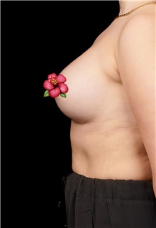 Breast Augmentation After Photo by Guncel Ozturk, Assoc. Prof. Dr, FEBOPRAS; Istanbul, M - Case 51003