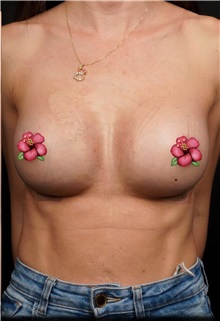 Breast Augmentation After Photo by Guncel Ozturk, Assoc. Prof. Dr, FEBOPRAS; Istanbul, M - Case 51001