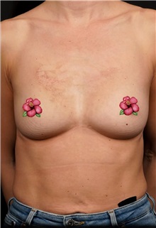 Breast Augmentation Before Photo by Guncel Ozturk, Assoc. Prof. Dr, FEBOPRAS; Istanbul, M - Case 51001