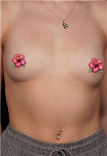 Breast Augmentation Before Photo by Guncel Ozturk, Assoc. Prof. Dr, FEBOPRAS; Istanbul, M - Case 50997