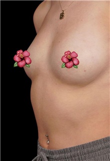 Breast Augmentation Before Photo by Guncel Ozturk, Assoc. Prof. Dr, FEBOPRAS; Istanbul, M - Case 50997