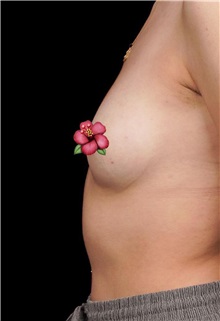 Breast Augmentation Before Photo by Guncel Ozturk, Assoc. Prof. Dr, FEBOPRAS; Istanbul, M - Case 50997