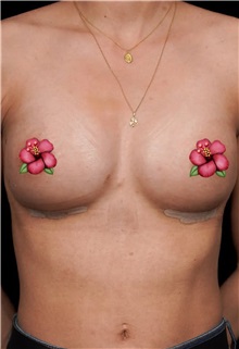 Breast Augmentation After Photo by Guncel Ozturk, Assoc. Prof. Dr, FEBOPRAS; Istanbul, M - Case 51000