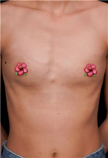 Breast Augmentation Before Photo by Guncel Ozturk, Assoc. Prof. Dr, FEBOPRAS; Istanbul, M - Case 51000