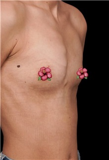 Breast Augmentation Before Photo by Guncel Ozturk, Assoc. Prof. Dr, FEBOPRAS; Istanbul, M - Case 51000