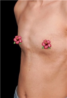 Breast Augmentation Before Photo by Guncel Ozturk, Assoc. Prof. Dr, FEBOPRAS; Istanbul, M - Case 51000