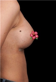 Breast Augmentation After Photo by Guncel Ozturk, Assoc. Prof. Dr, FEBOPRAS; Istanbul, M - Case 51000