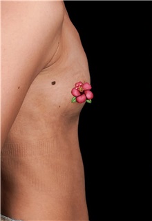 Breast Augmentation Before Photo by Guncel Ozturk, Assoc. Prof. Dr, FEBOPRAS; Istanbul, M - Case 51000