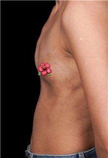 Breast Augmentation Before Photo by Guncel Ozturk, Assoc. Prof. Dr, FEBOPRAS; Istanbul, M - Case 51000