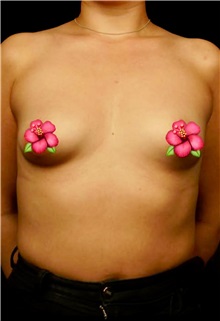 Breast Augmentation Before Photo by Guncel Ozturk, Assoc. Prof. Dr, FEBOPRAS; Istanbul, M - Case 51002