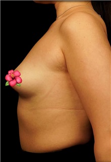 Breast Augmentation Before Photo by Guncel Ozturk, Assoc. Prof. Dr, FEBOPRAS; Istanbul, M - Case 51002