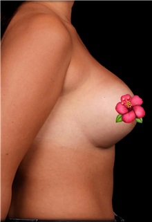 Breast Augmentation After Photo by Guncel Ozturk, Assoc. Prof. Dr, FEBOPRAS; Istanbul, M - Case 51002