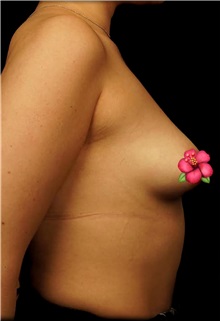 Breast Augmentation Before Photo by Guncel Ozturk, Assoc. Prof. Dr, FEBOPRAS; Istanbul, M - Case 51002