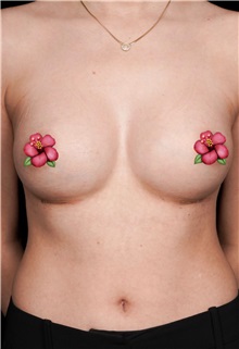 Breast Augmentation After Photo by Guncel Ozturk, Assoc. Prof. Dr, FEBOPRAS; Istanbul, M - Case 51004