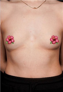Breast Augmentation Before Photo by Guncel Ozturk, Assoc. Prof. Dr, FEBOPRAS; Istanbul, M - Case 51004