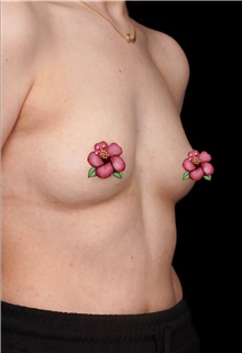 Breast Augmentation Before Photo by Guncel Ozturk, Assoc. Prof. Dr, FEBOPRAS; Istanbul, M - Case 51004