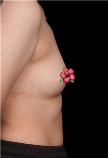 Breast Augmentation Before Photo by Guncel Ozturk, Assoc. Prof. Dr, FEBOPRAS; Istanbul, M - Case 51004