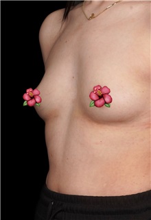 Breast Augmentation Before Photo by Guncel Ozturk, Assoc. Prof. Dr, FEBOPRAS; Istanbul, M - Case 51004