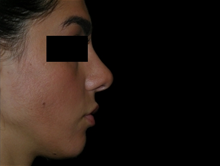 Rhinoplasty After Photo by Michelle Copeland, MD, DMD, FACS, PC; New York, NY - Case 25849
